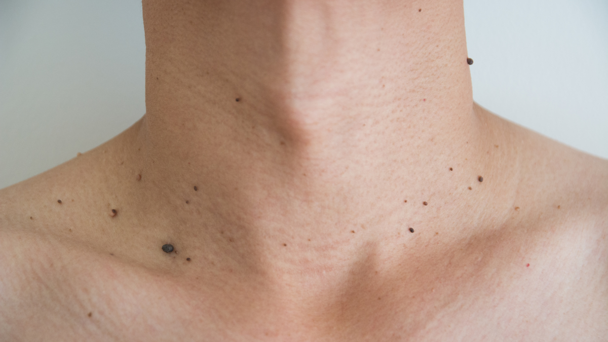 Los acrocordones, también conocidos como fibromas blandos o pólipos fibroepiteliales, son pequeñas protuberancias benignas que se desarrollan en la piel.