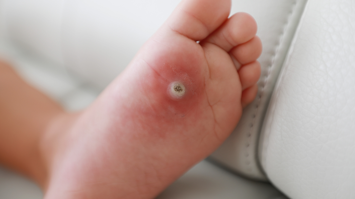 Las verrugas plantares son comunes pero tratables. Te contamos cómo eliminarlas paso a paso y prevenir su contagio.