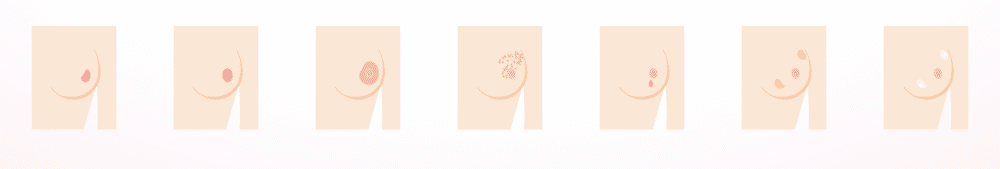 Paso 1 autoexploración mamaria anormalidades